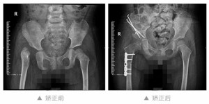 技术｜孩子外伤了怎么办，别担心，儿童骨科有办法