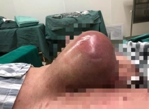 技术｜一巨大腹股沟斜疝（阴囊疝）被我院疝外科团队成功修补